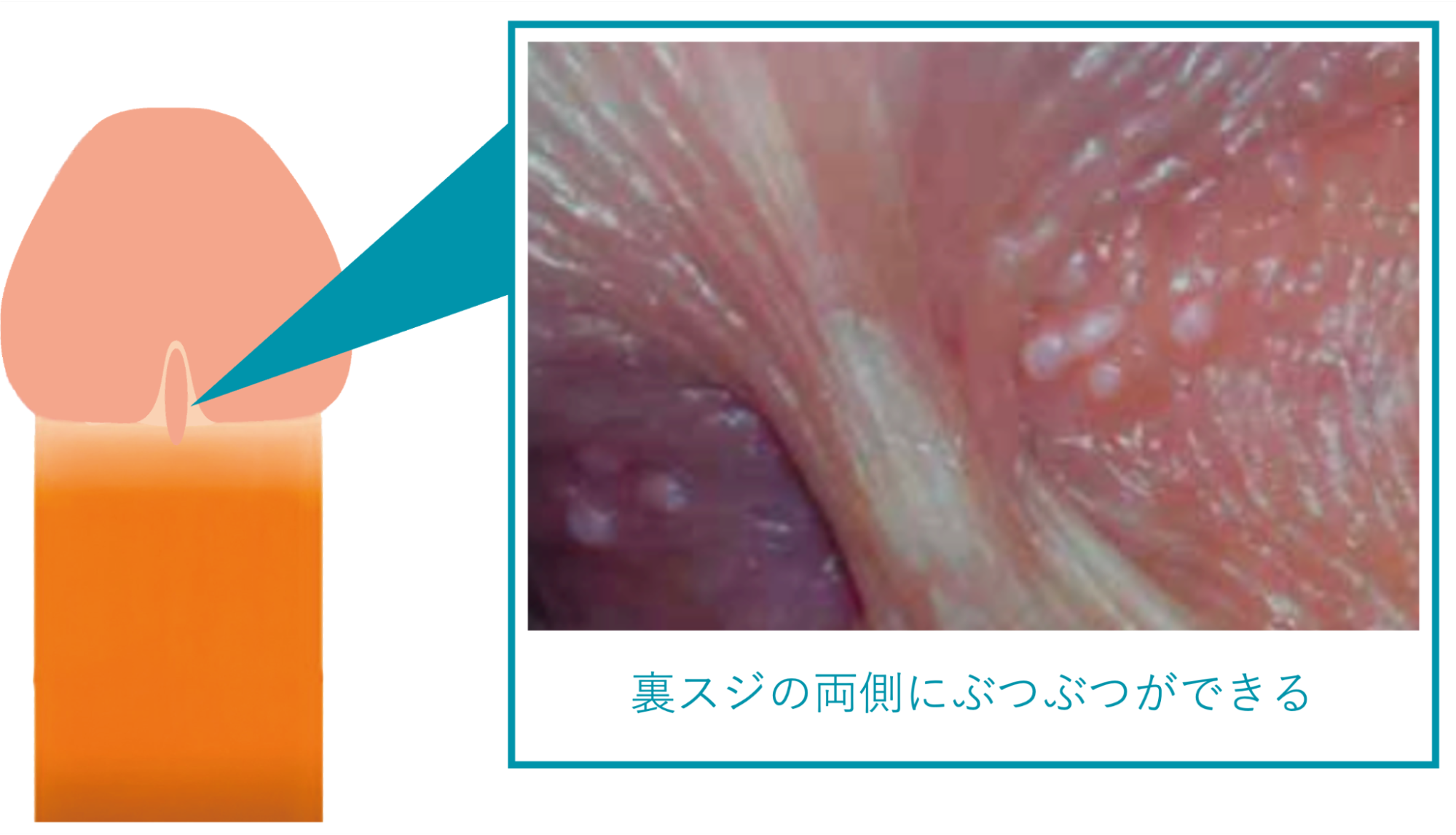 包皮腺（タイソン腺）でぶつぶつになった症例