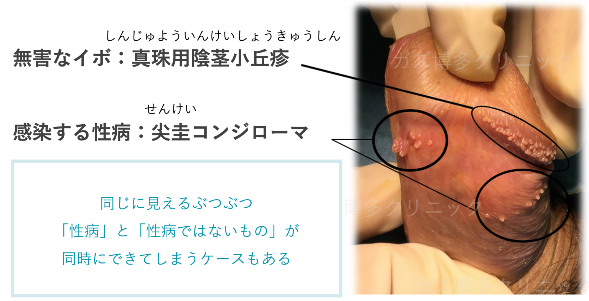 真珠様陰茎小丘疹と尖圭コンジローマが同時発症した症例