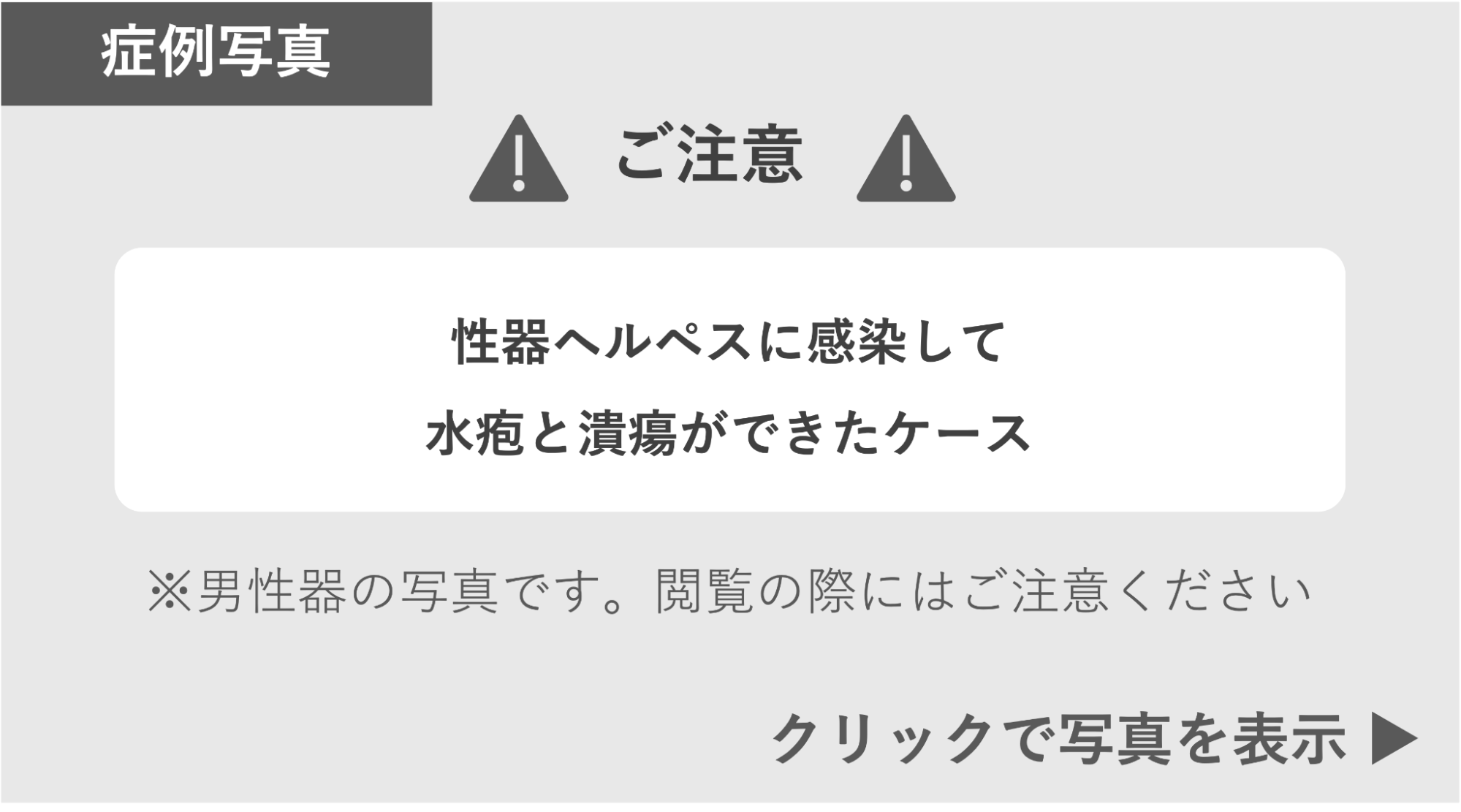 性器ヘルペスに感染して水疱と潰瘍ができた症例 症例写真閲覧の警告