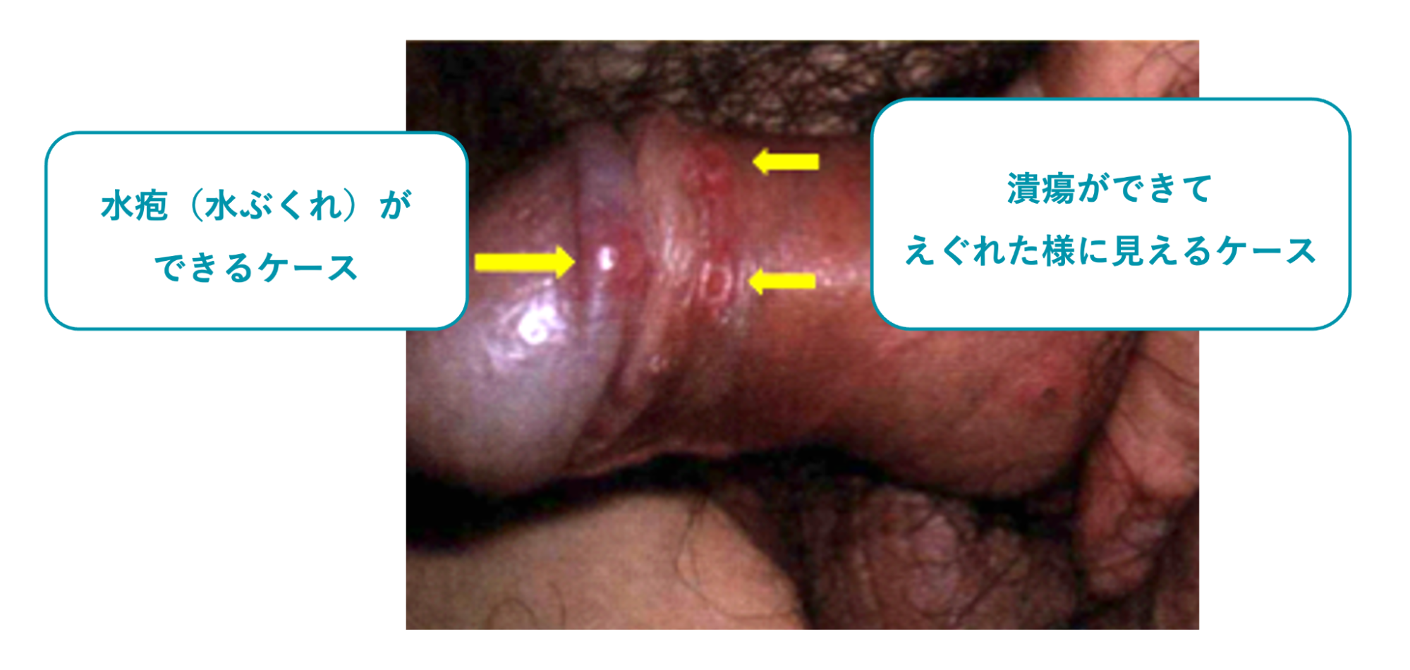 梅毒に感染してしこりと潰瘍ができた症例