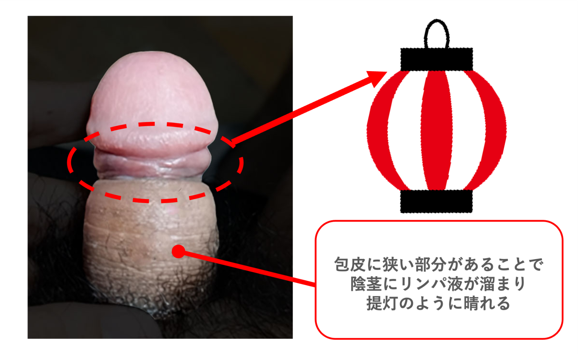 包茎手術後にリンパ液が滲んで提灯変形になった症例
