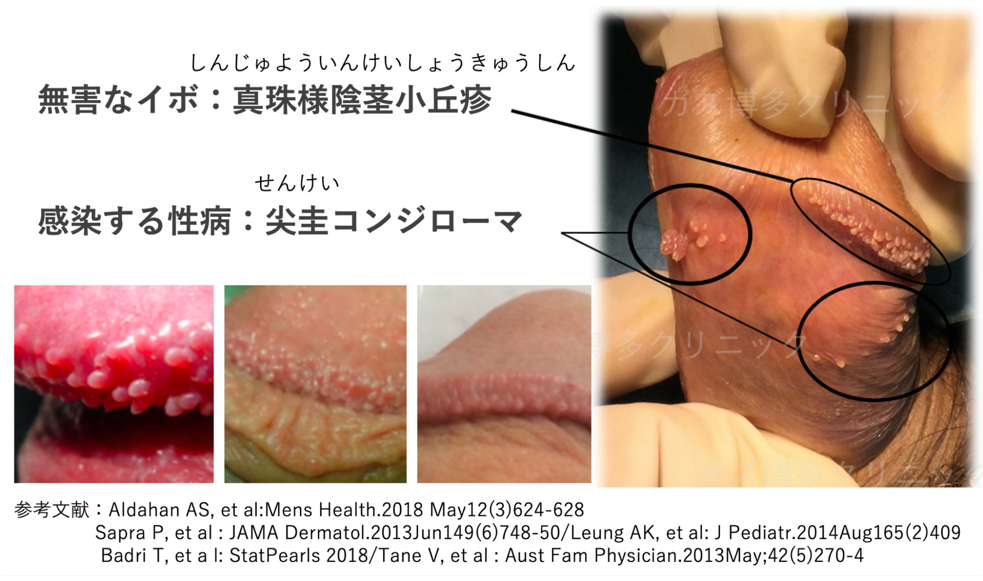 真珠様陰茎小丘疹で亀頭冠がぶつぶつになった症例
