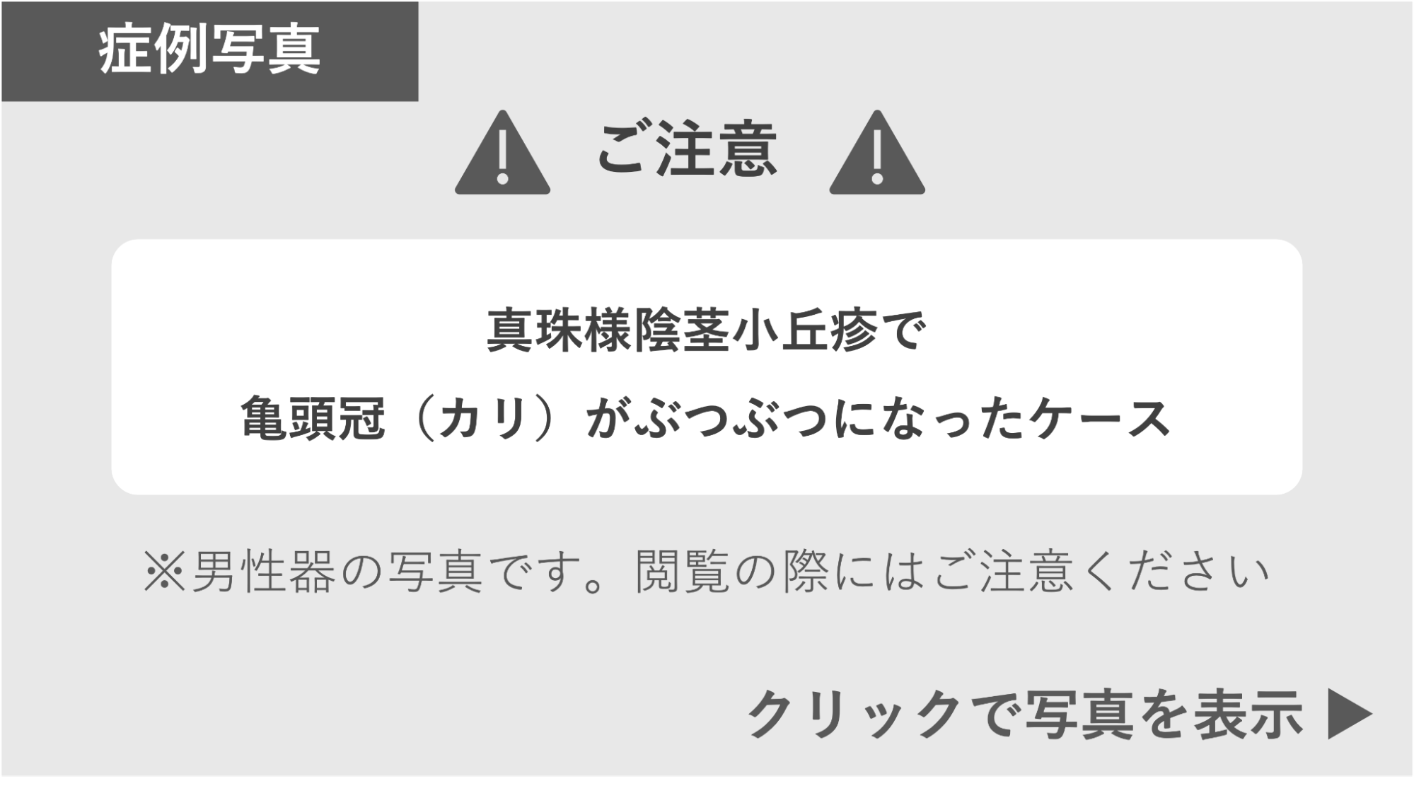 真珠様陰茎小丘疹で亀頭冠がぶつぶつになった症例 症例写真閲覧の警告