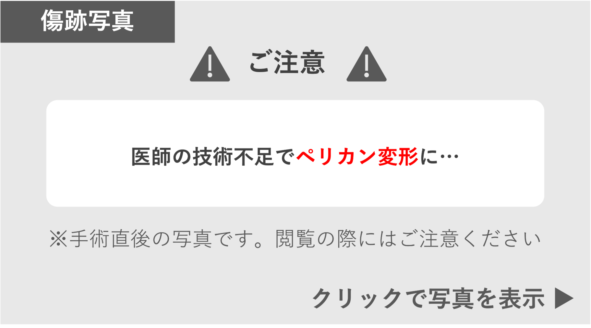 医師の技術不足でペリカン変形になった症例 症例写真閲覧の警告