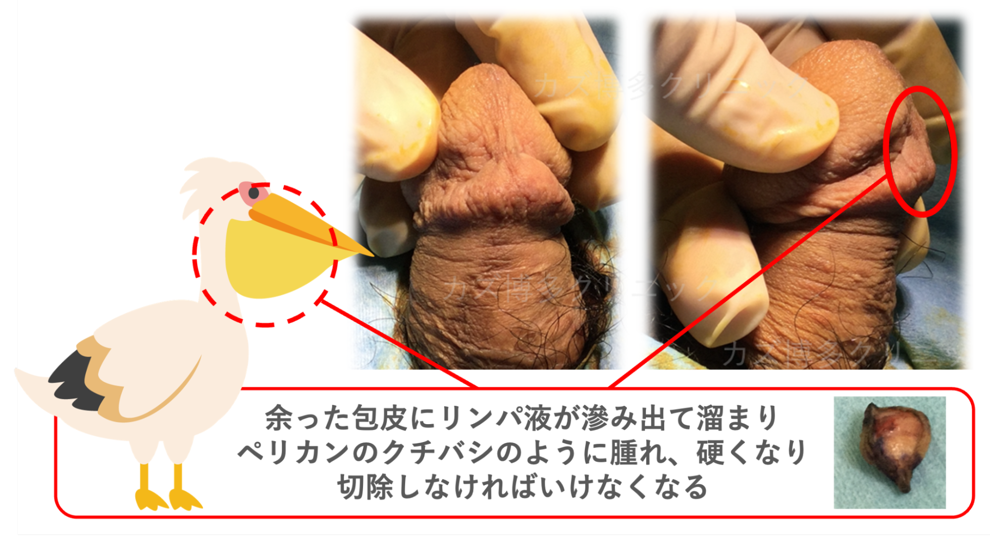医師の技術不足でペリカン変形になった症例