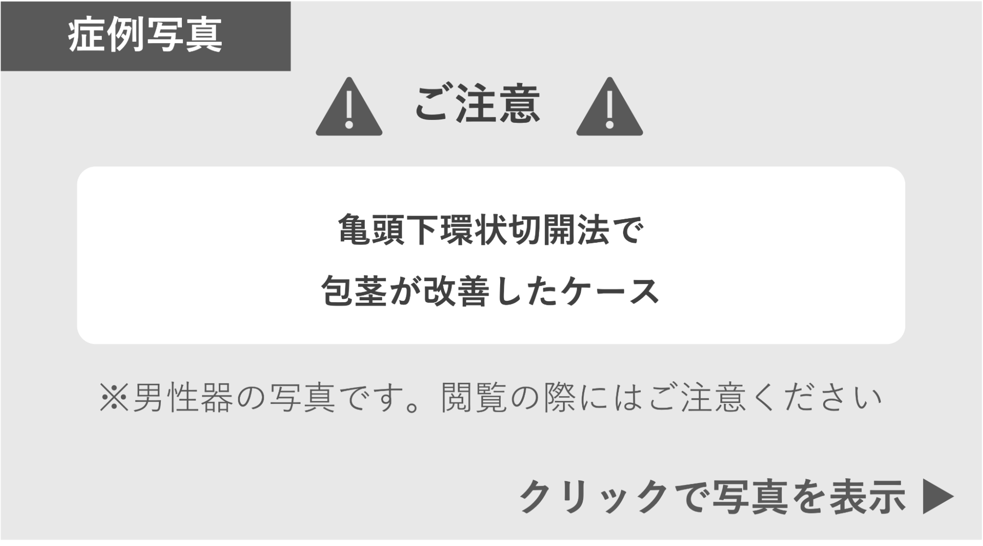 亀頭下環状切開法で包茎が改善した症例 症例写真閲覧の警告