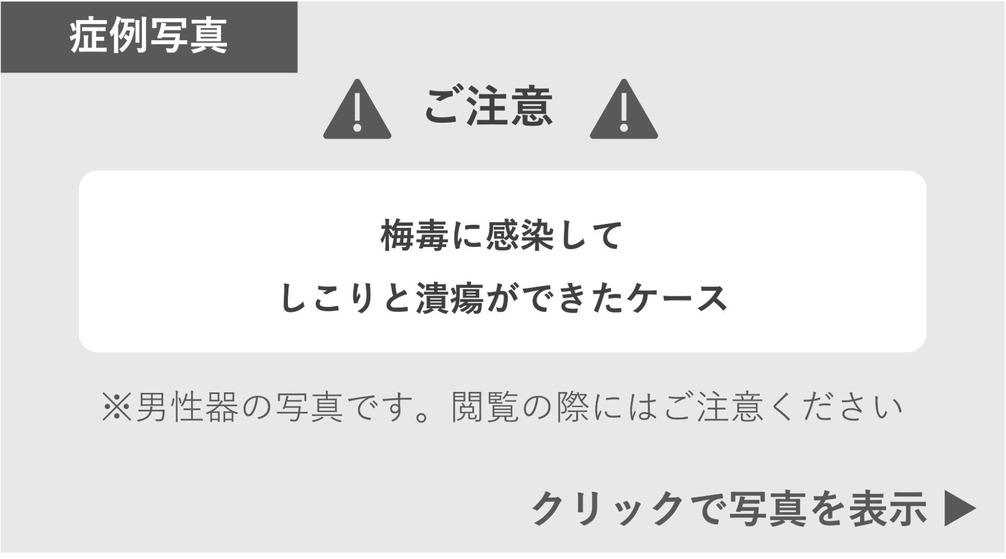 梅毒に感染してしこりと潰瘍ができた症例 症例写真閲覧の警告