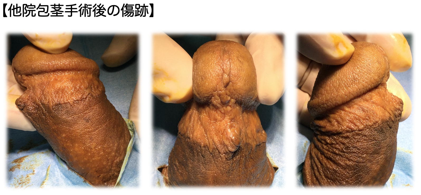 ツートンカラーで違和感のある仕上がりになった症例