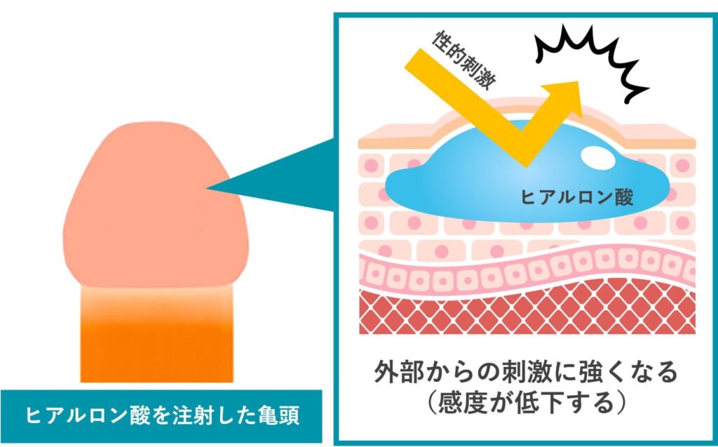 ヒアルロン酸を注射したことで感度が弱くなることを解説した図