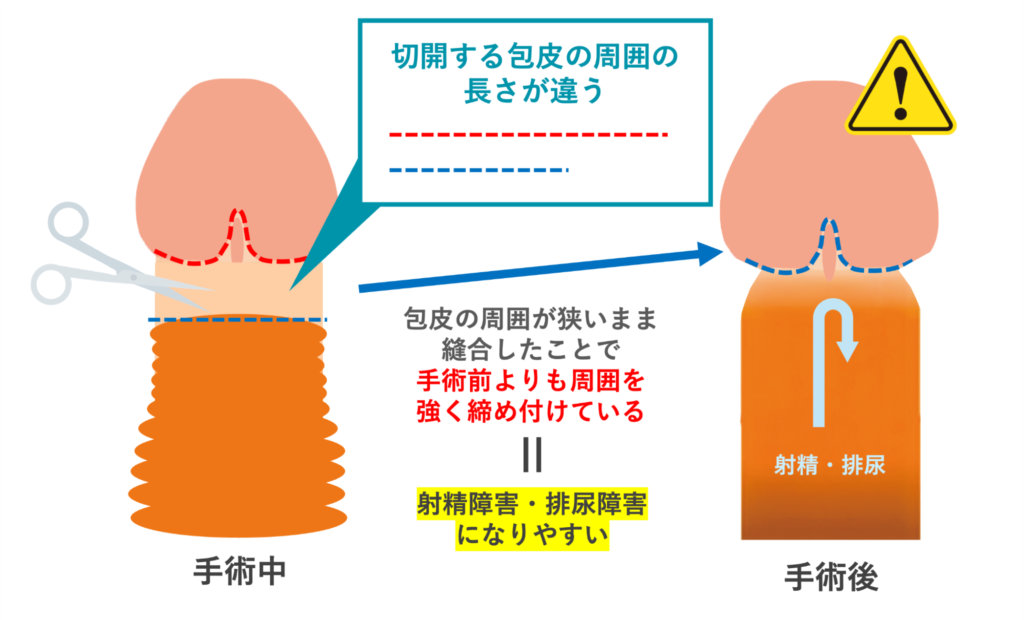 包茎手術により射精障害・排尿障害になる原因を説明した図