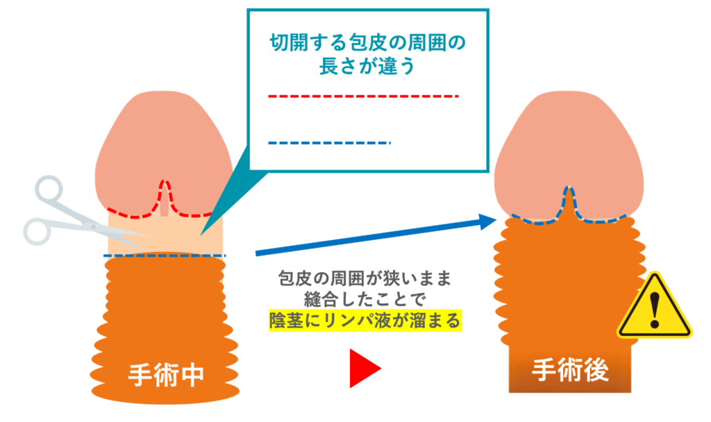 提灯変形になる原因を説明した図