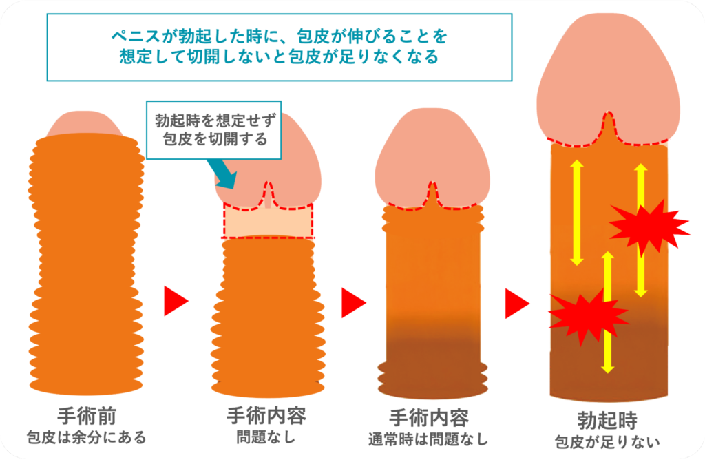 包茎手術した後で勃起した時に痛みや違和感がおこる原因を説明した図
