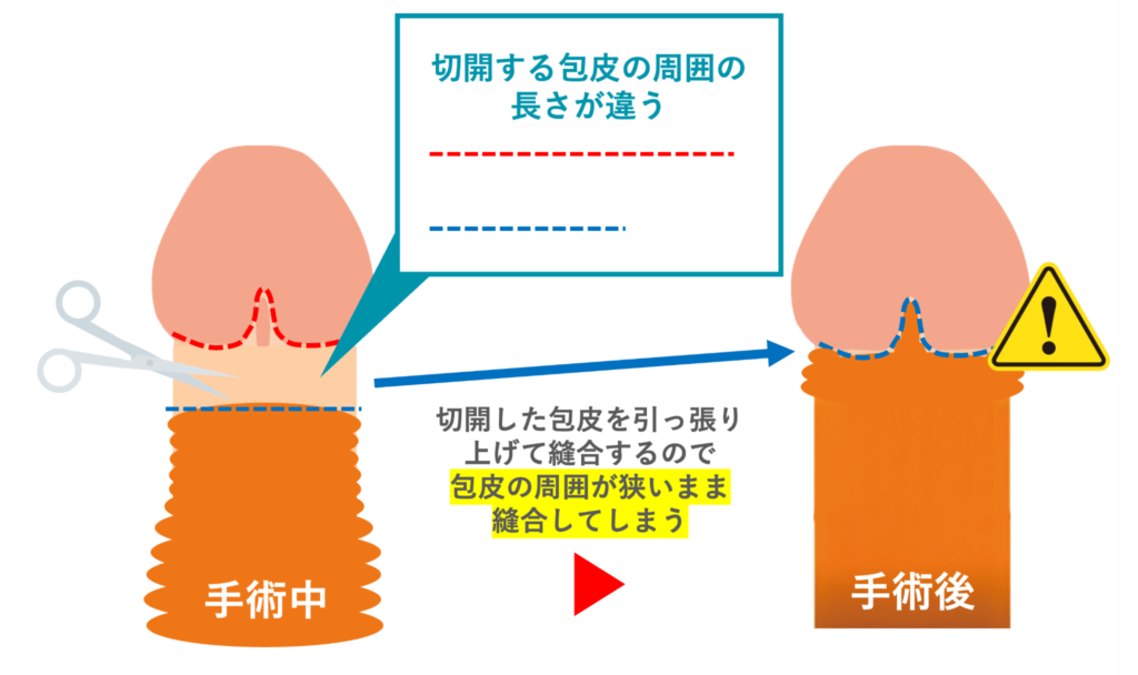 ペリカン変形になる原因を説明した図