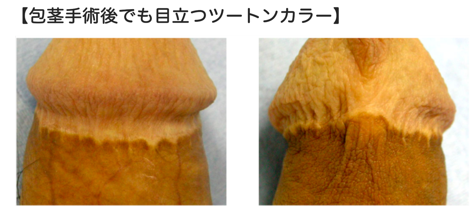 縫合部分がツートンカラーになった症例1