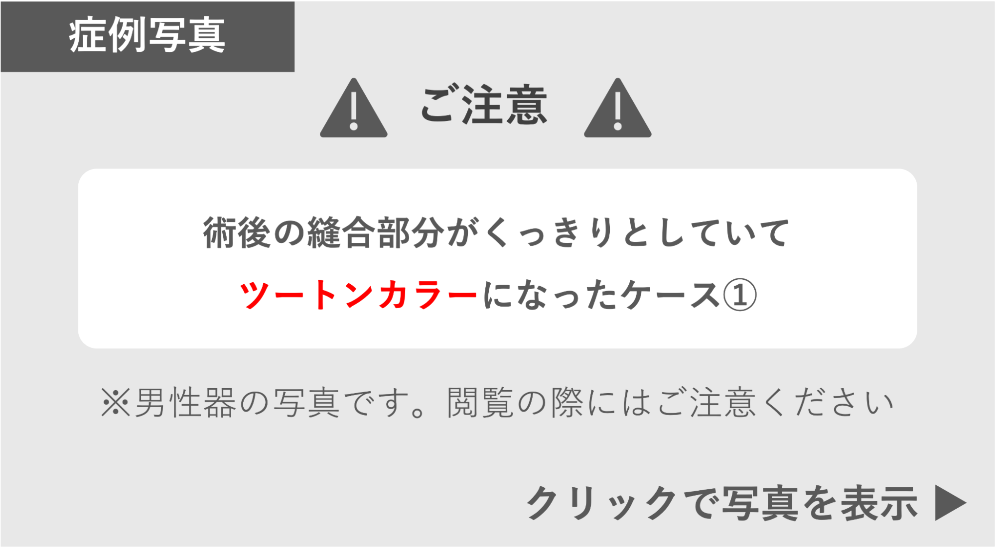 縫合部分がツートンカラーになった症例1 症例写真閲覧の警告