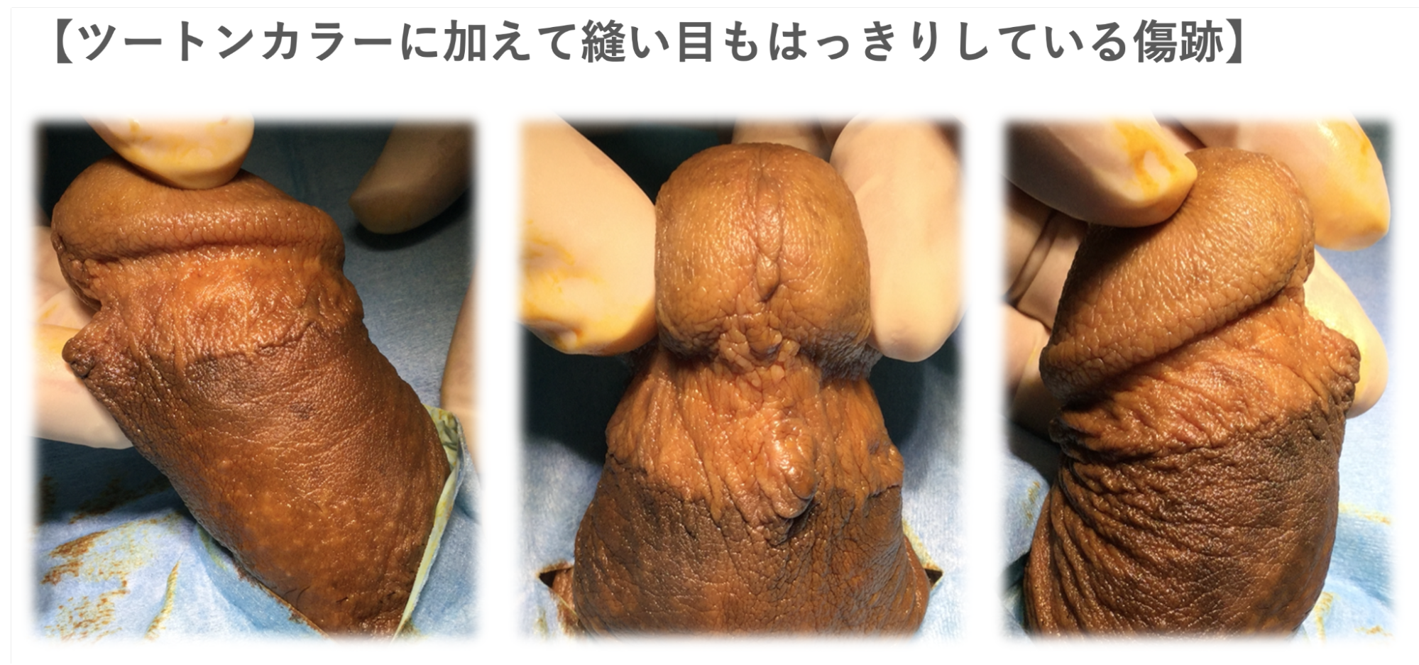 縫合部分がツートンカラーになった症例2