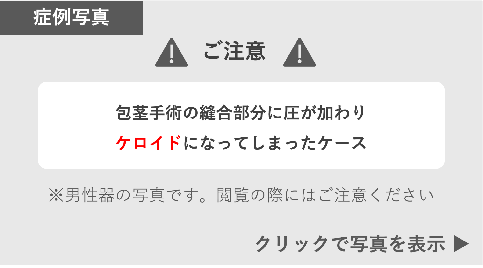 包茎手術の縫合部分に圧が加わりケロイドになった症例 症例写真閲覧の警告