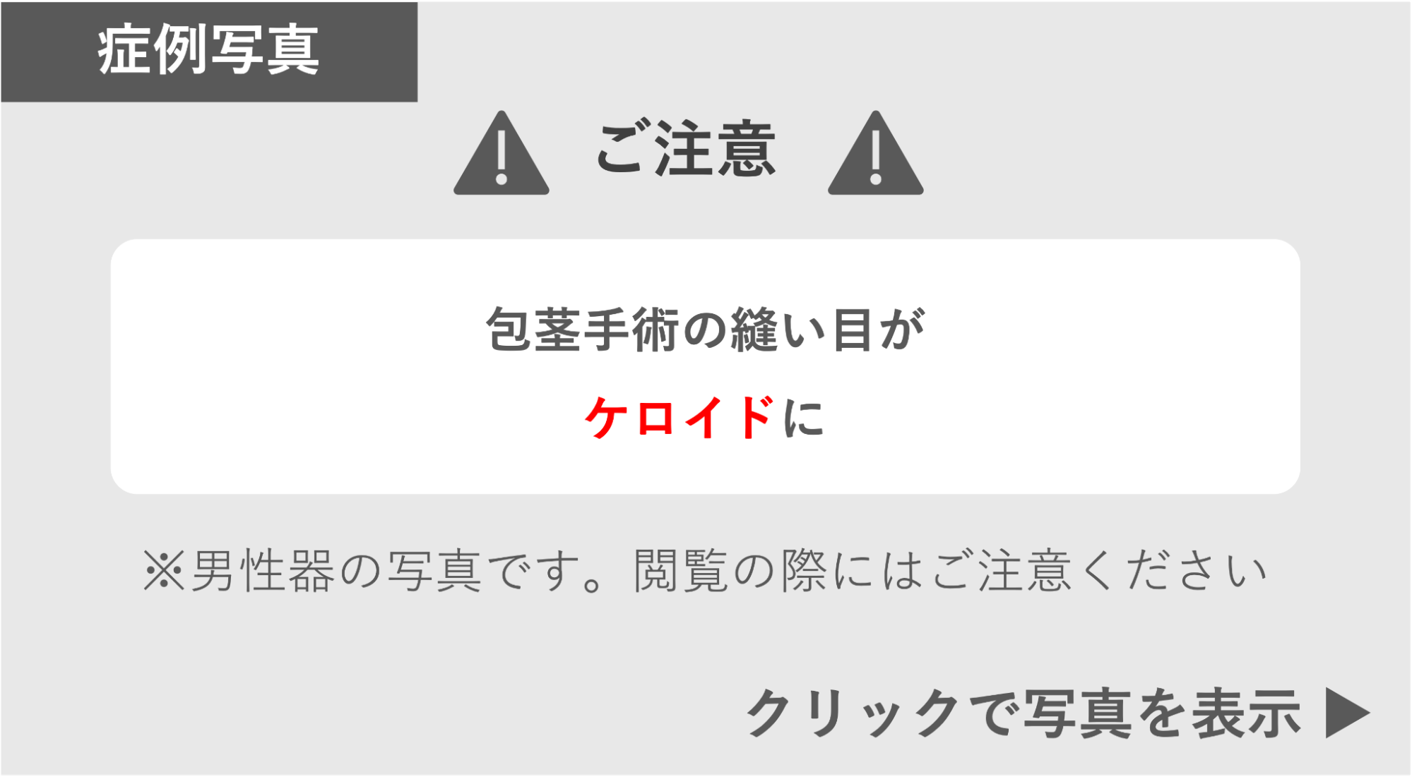 包茎手術の縫い目がケロイドになった症例 症例写真閲覧の警告