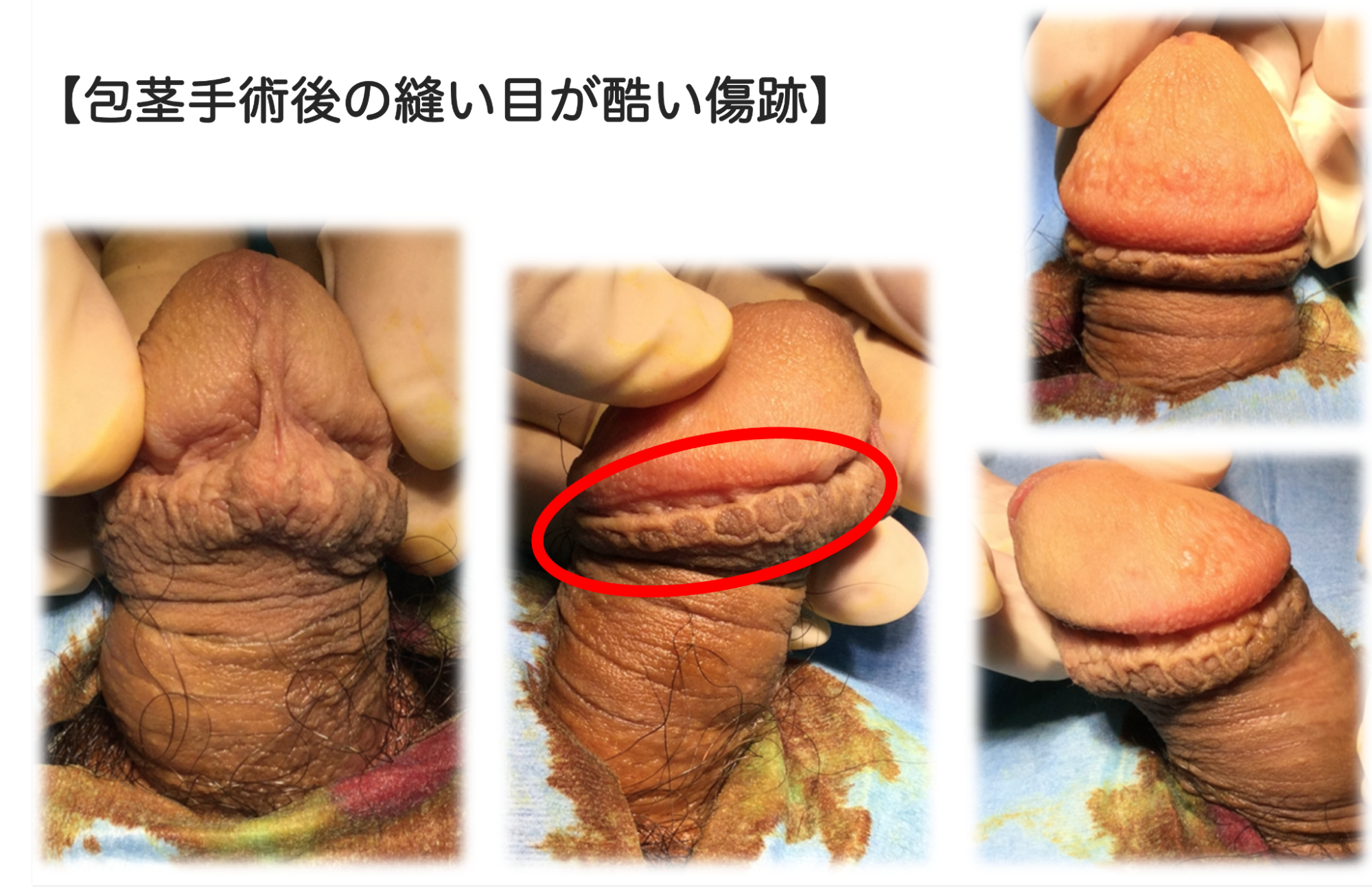 あきらかに目立つ縫い目が残った症例
