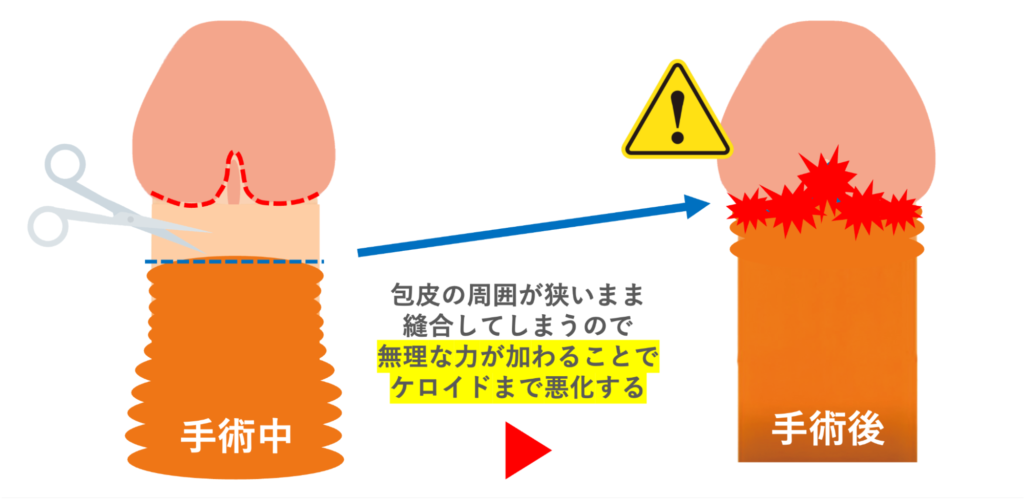 包茎手術でケロイドになる原因を説明した図