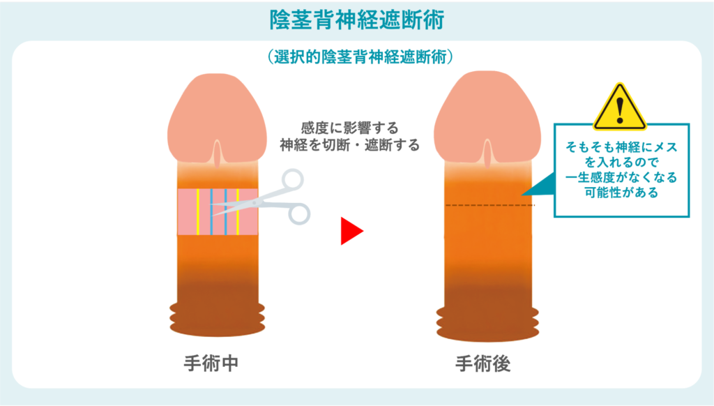 陰茎背神経遮断術のリスクを説明した図