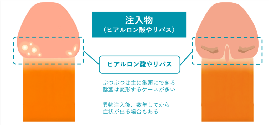注入物（ヒアルロン酸やリパス）の例