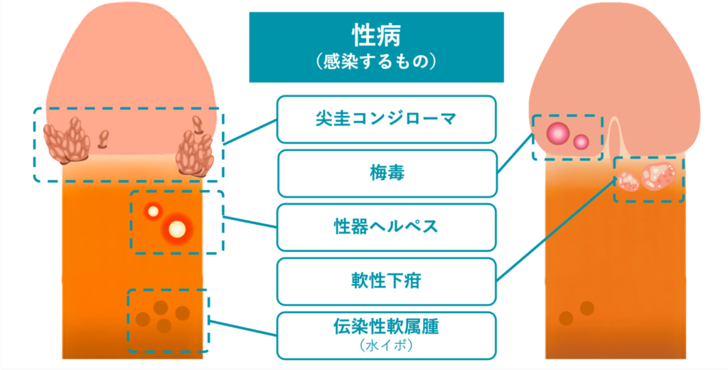 性病（感染するもの）の例