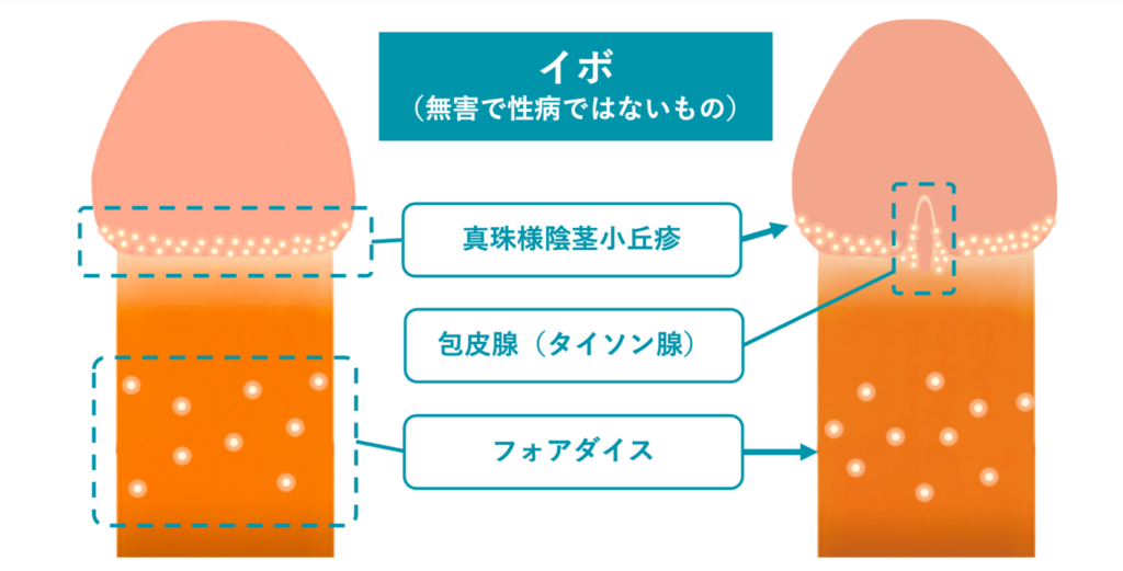 イボ（無害で性病ではないもの）の例