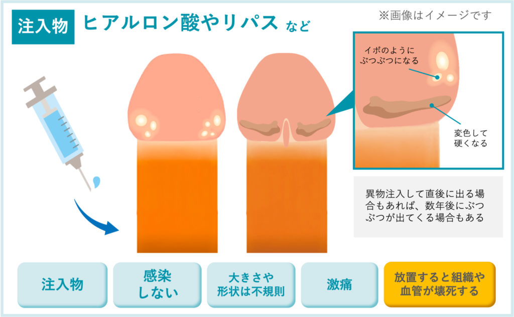 【注入物】ヒアルロン酸やリパスの凸凹