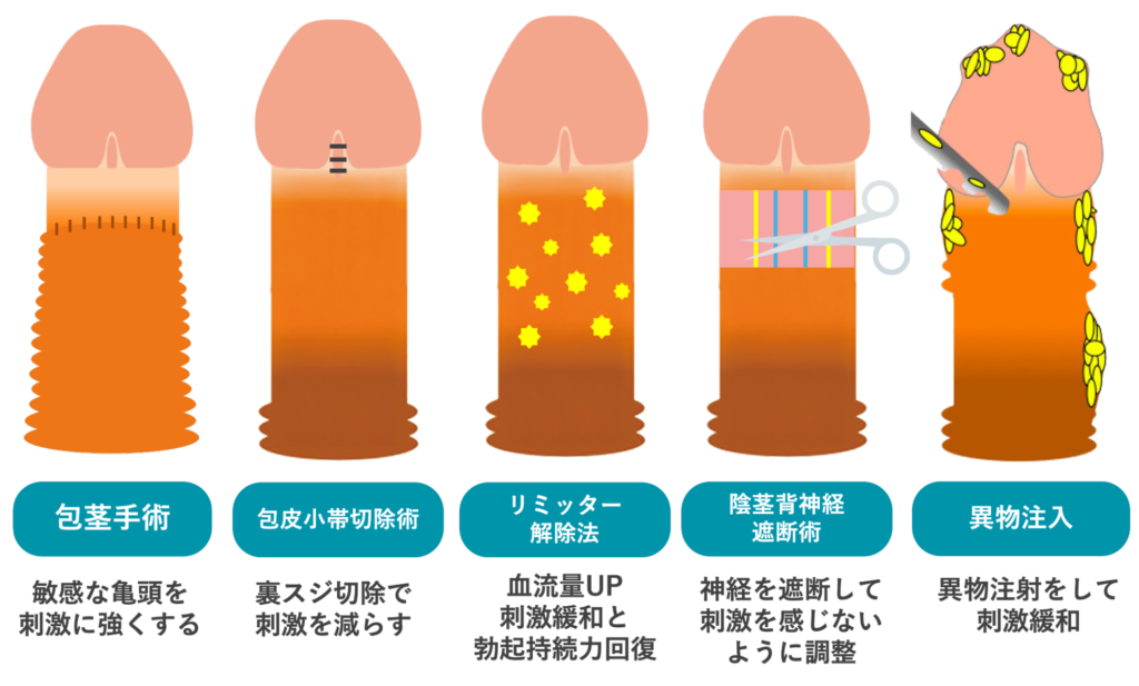 早漏治療の主な手術のイメージ