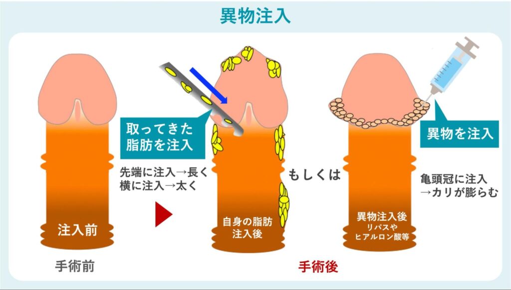 異物注入の概要