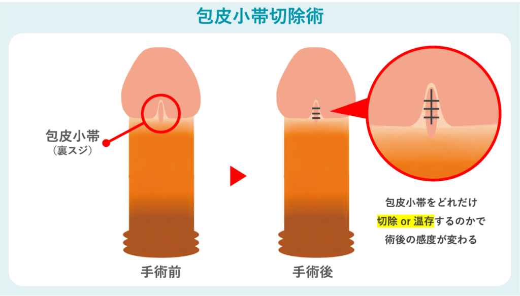 包皮小帯切除術の概要