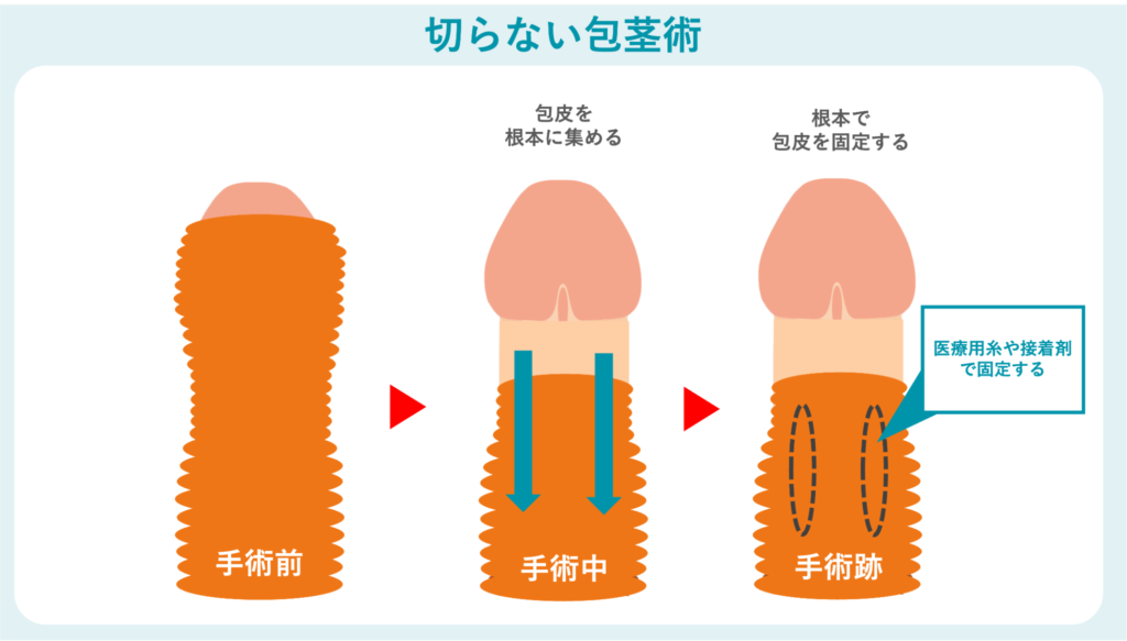 切らない包茎術の概要
