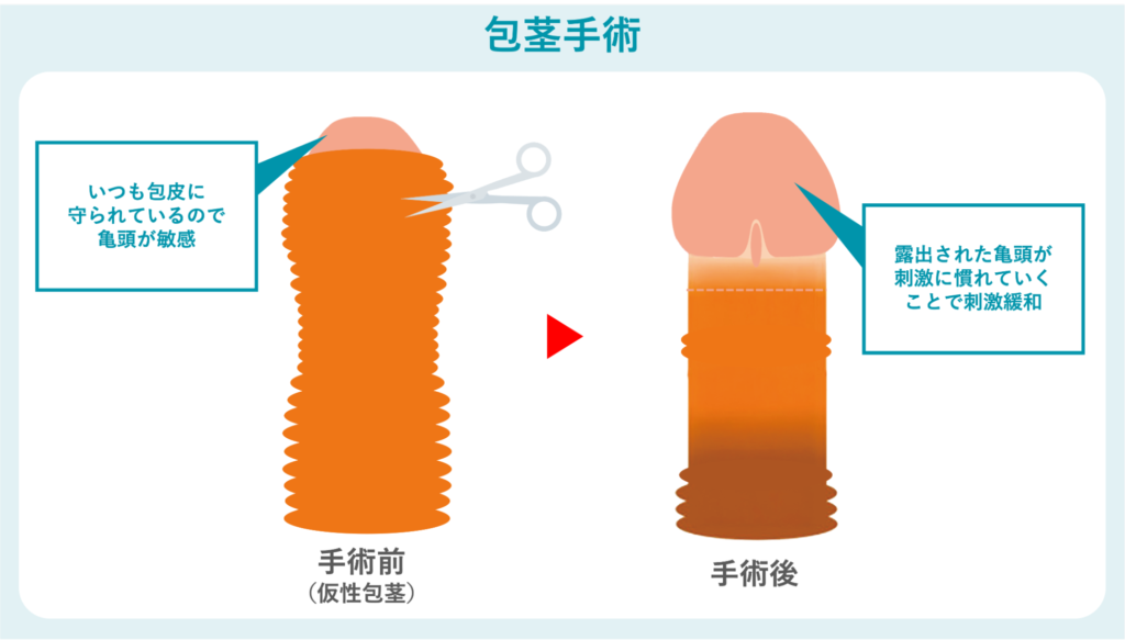 包茎手術の概要