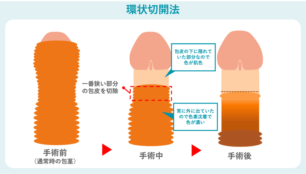 環状切開法の概要