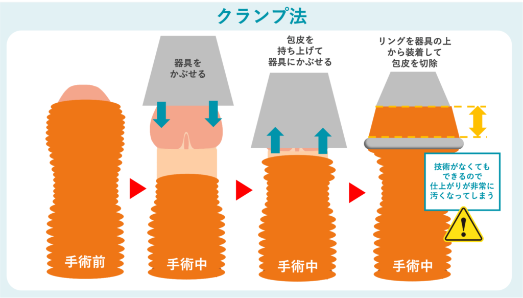クランプ法の概要