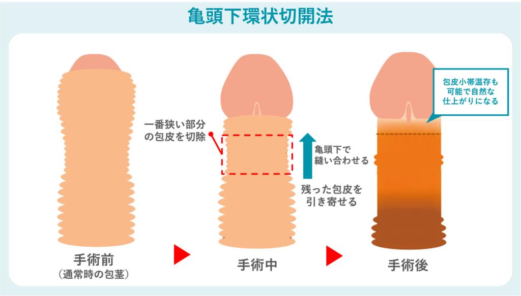 亀頭下環状切開法の概要