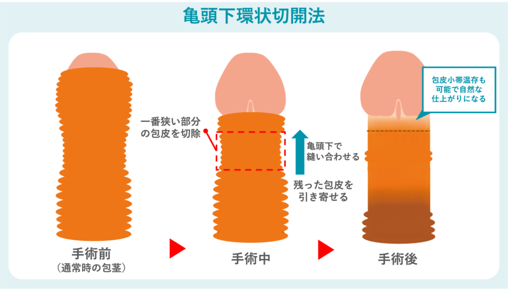 亀頭下環状切開法の概要