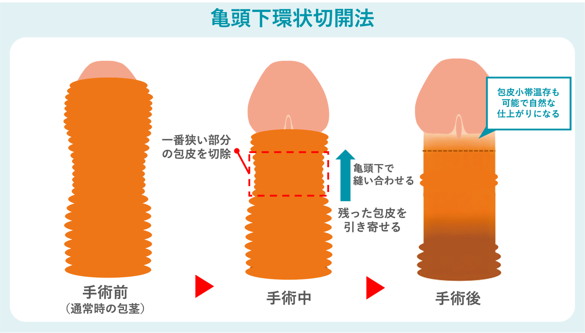 亀頭下環状切開法の概要