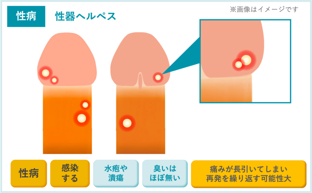 【性病】性器ヘルペス