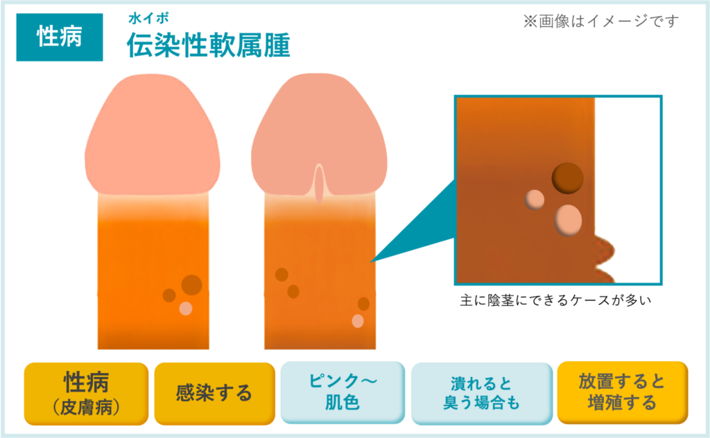 【性病】伝染性軟属腫（水イボ）