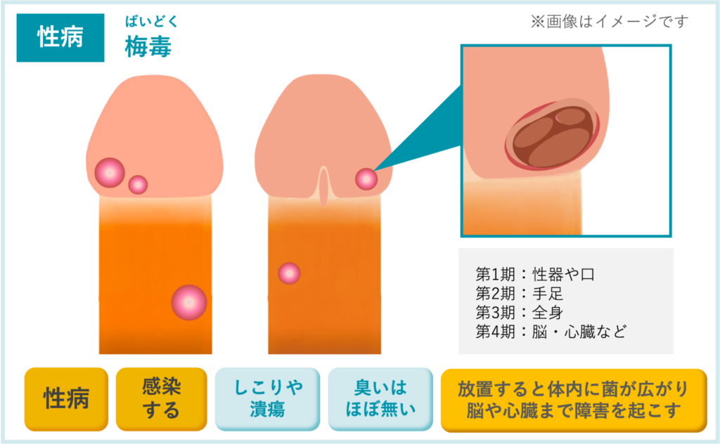 【性病】梅毒