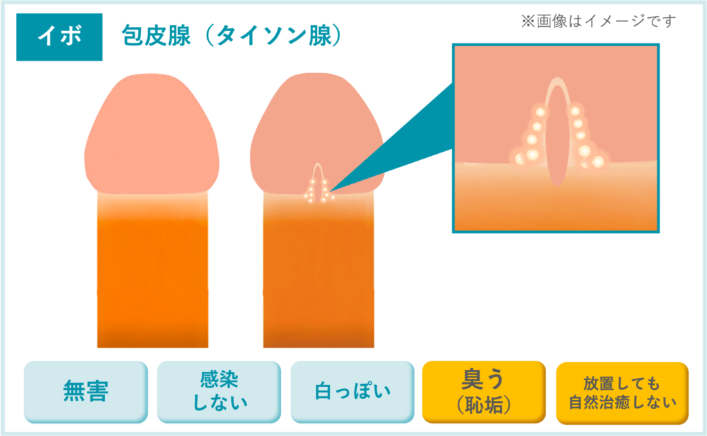 【イボ】包皮腺（タイソン腺）