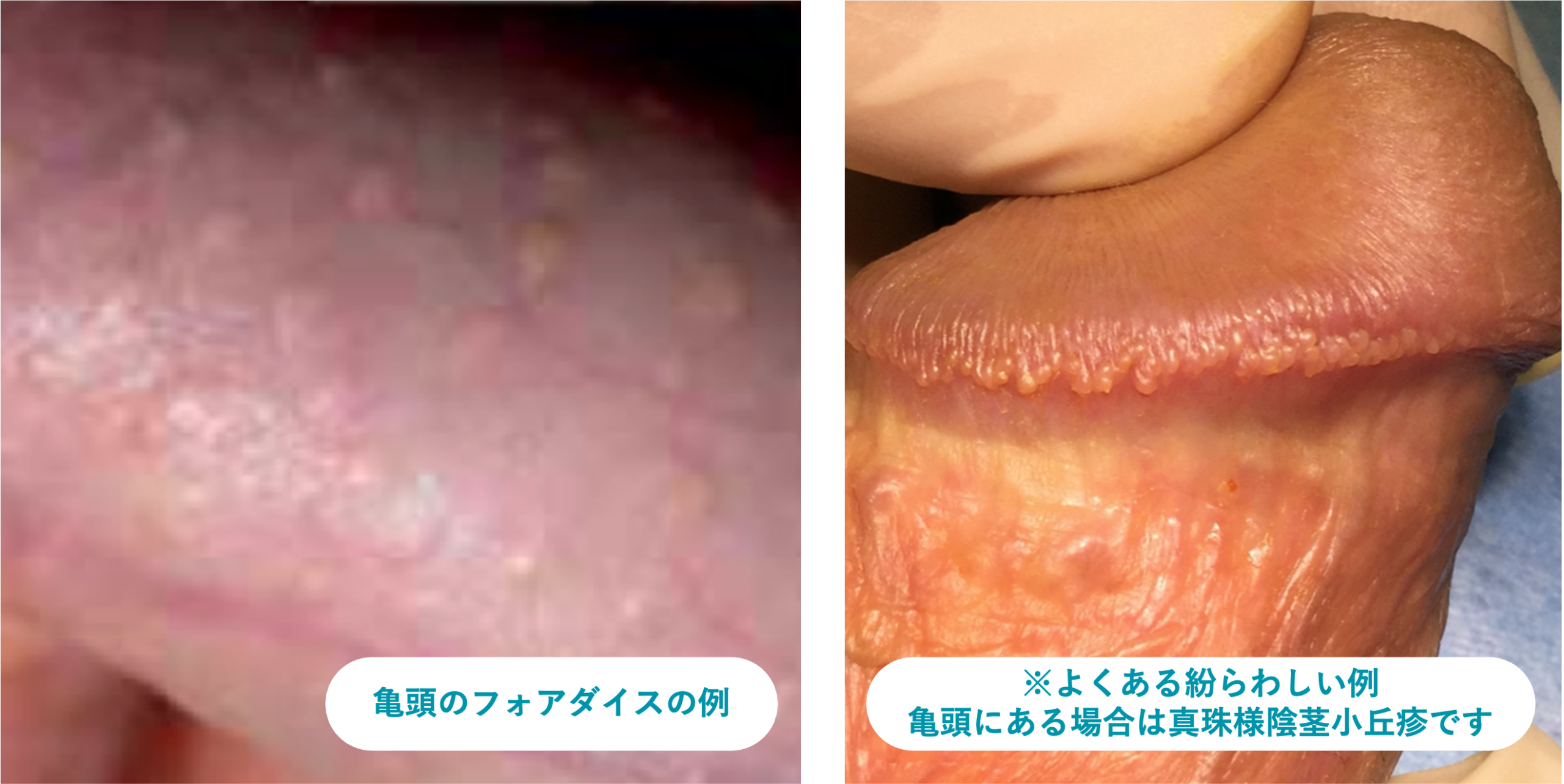ファボタイスでぶつぶつになった症例
