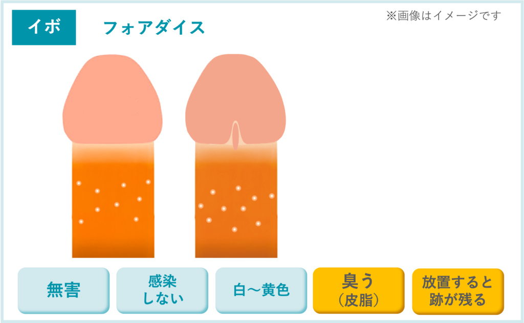【イボ】フォアダイス
