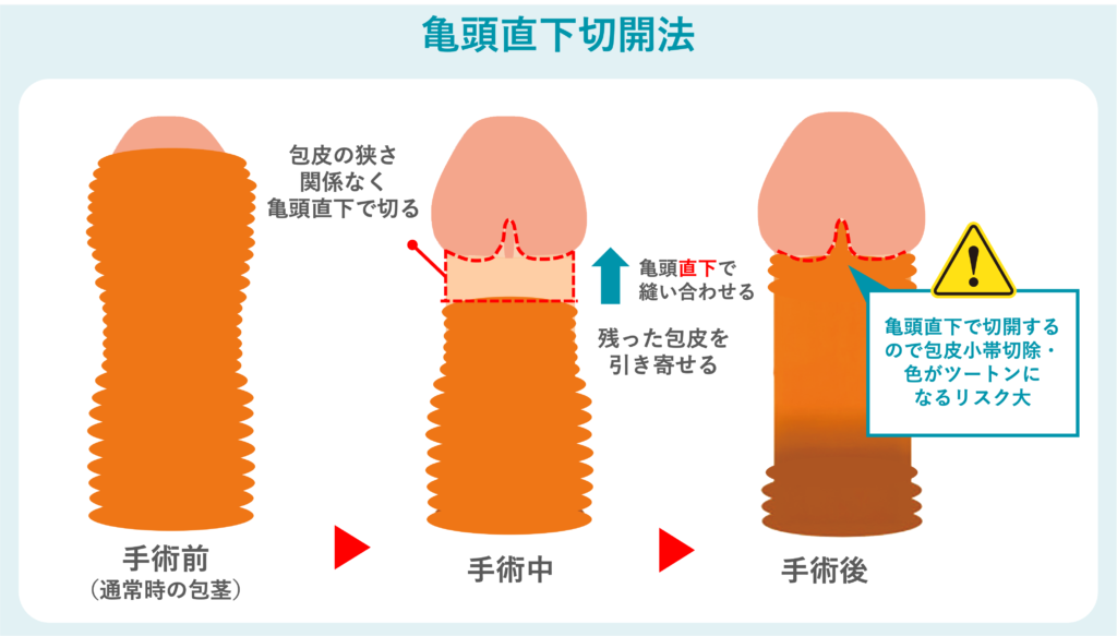 亀頭直下切開法の概要