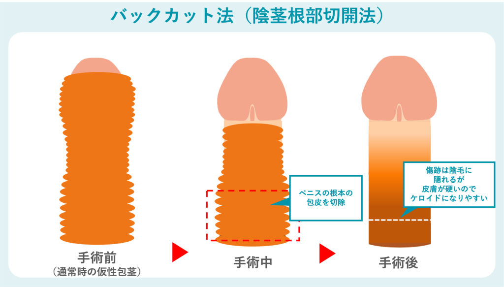 バックカット法の概要