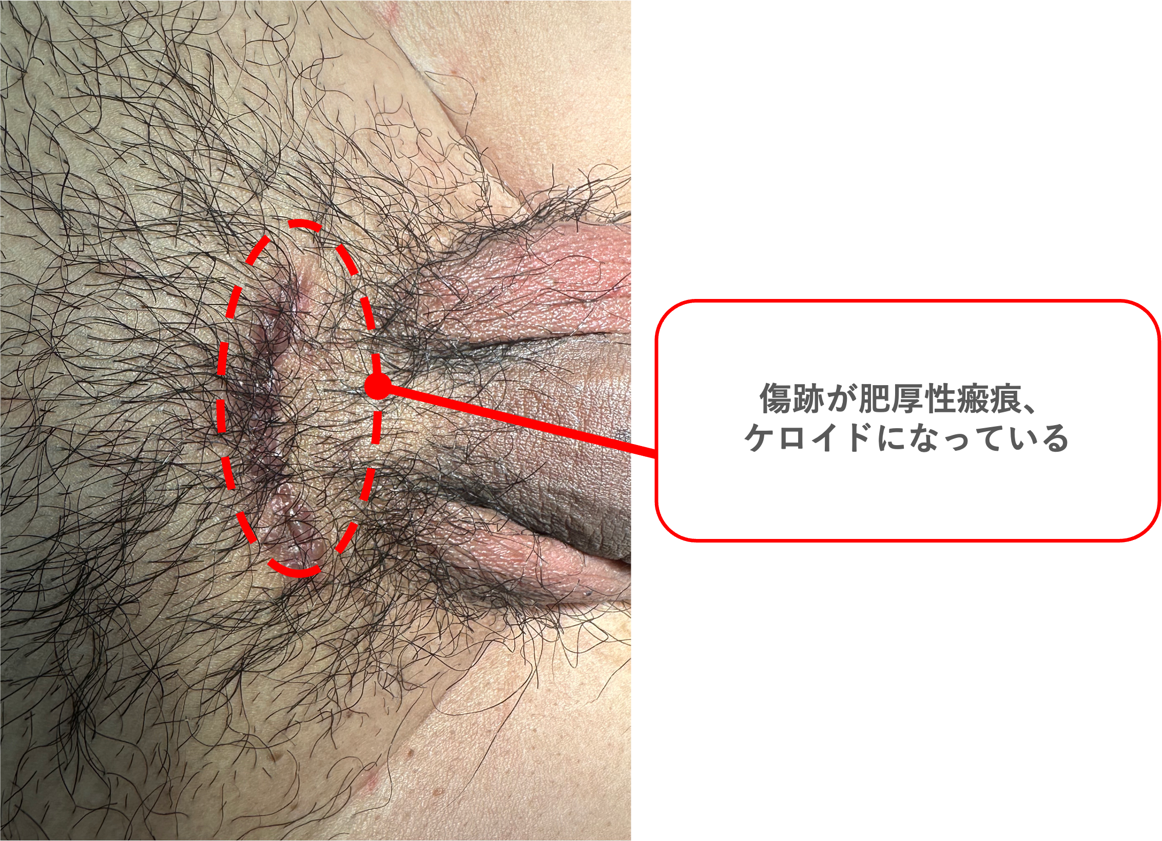 陰茎の傷跡が肥厚性瘢痕・ケロイドになった症例