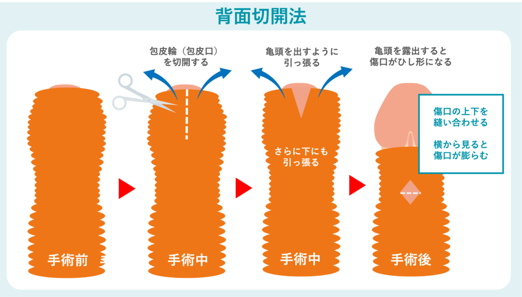 背面切開法の概要