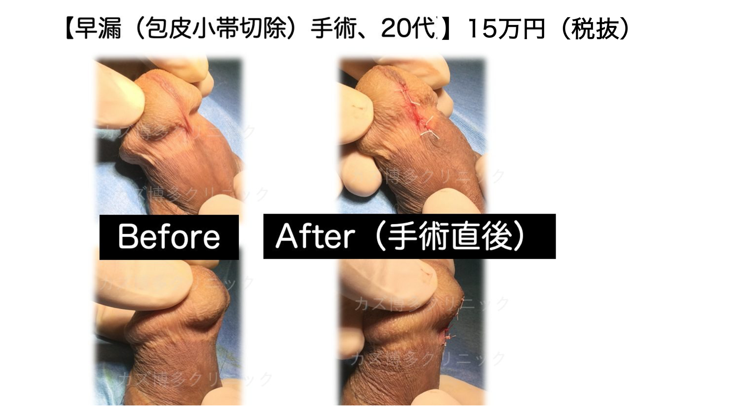 包皮小帯切除術で早漏が改善した症例